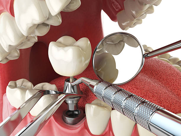 Best Lost Filling or Crown Replacement in Cologne, NJ